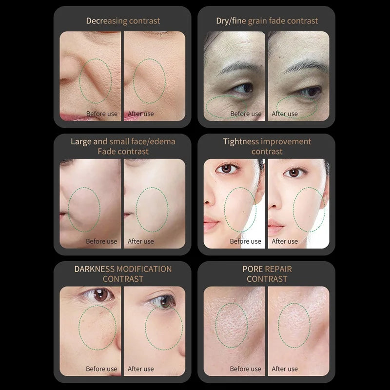 RF Skin Tightening Device
