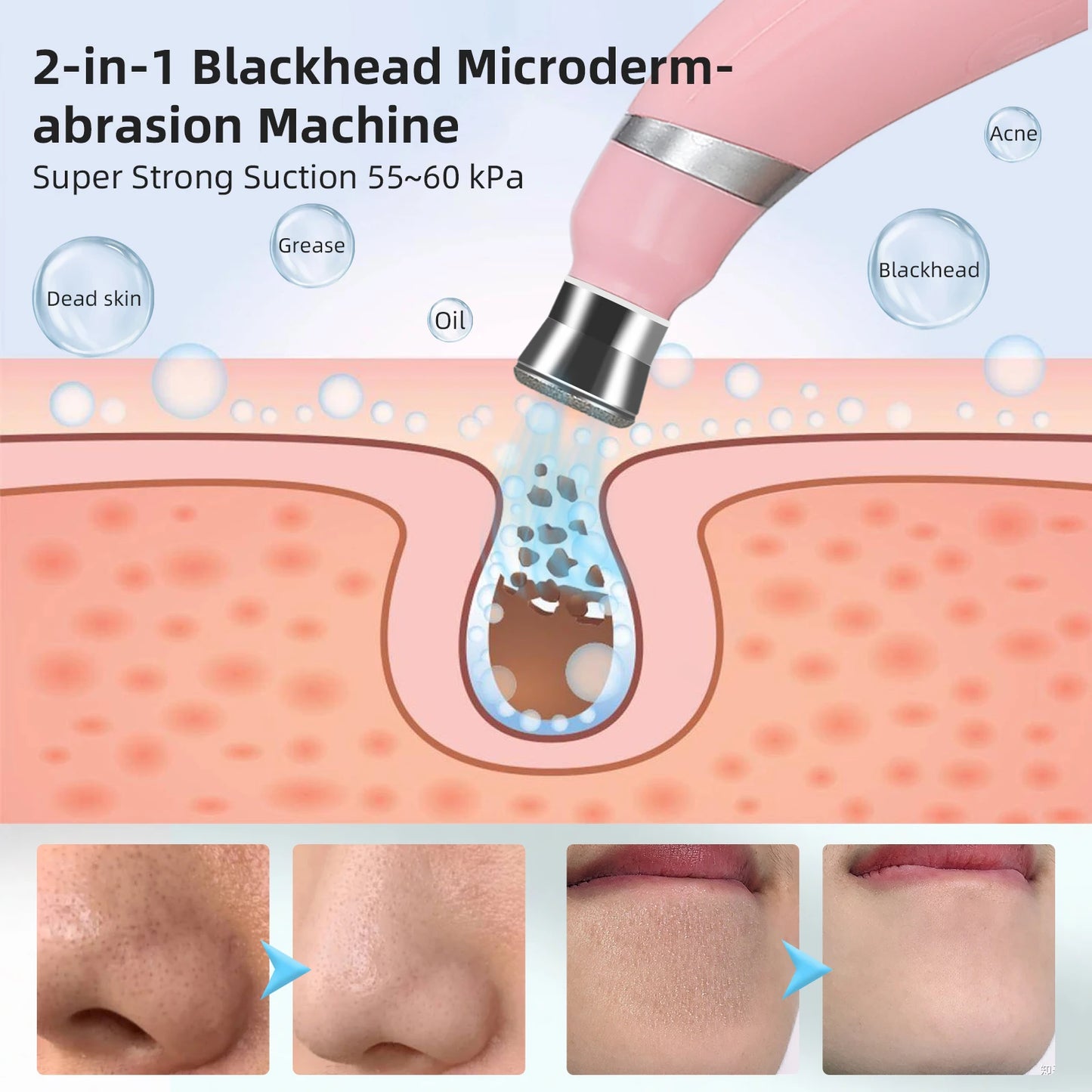 Microdermabrasion & Blackhead Remover