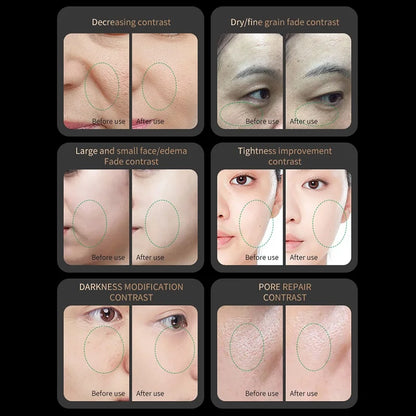 RF Skin Tightening Device